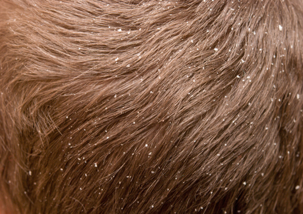 7 cosas que tu pelo dice sobre tu salud - La dermatitis seborreica